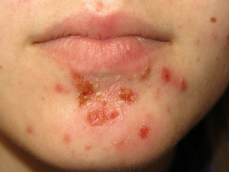 Close-up of impetigo sores and crusting around the mouth